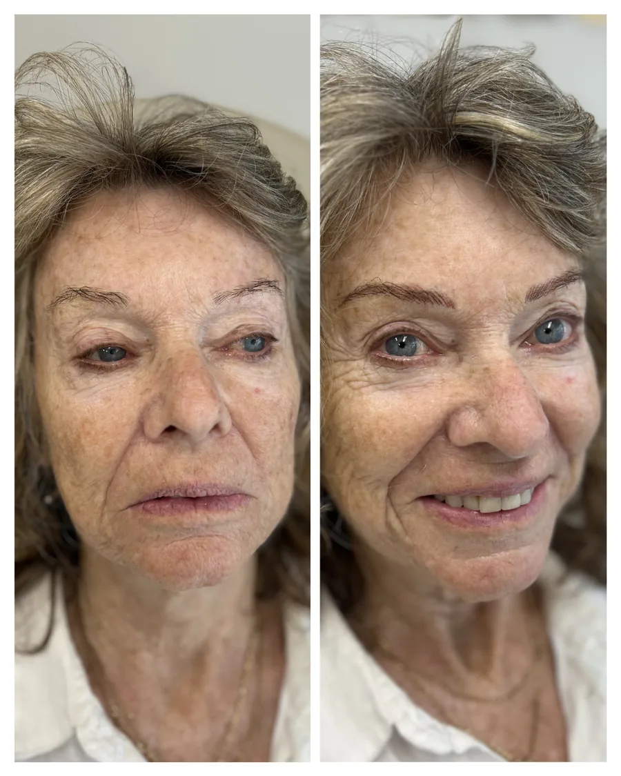 Client before and after brow restoration