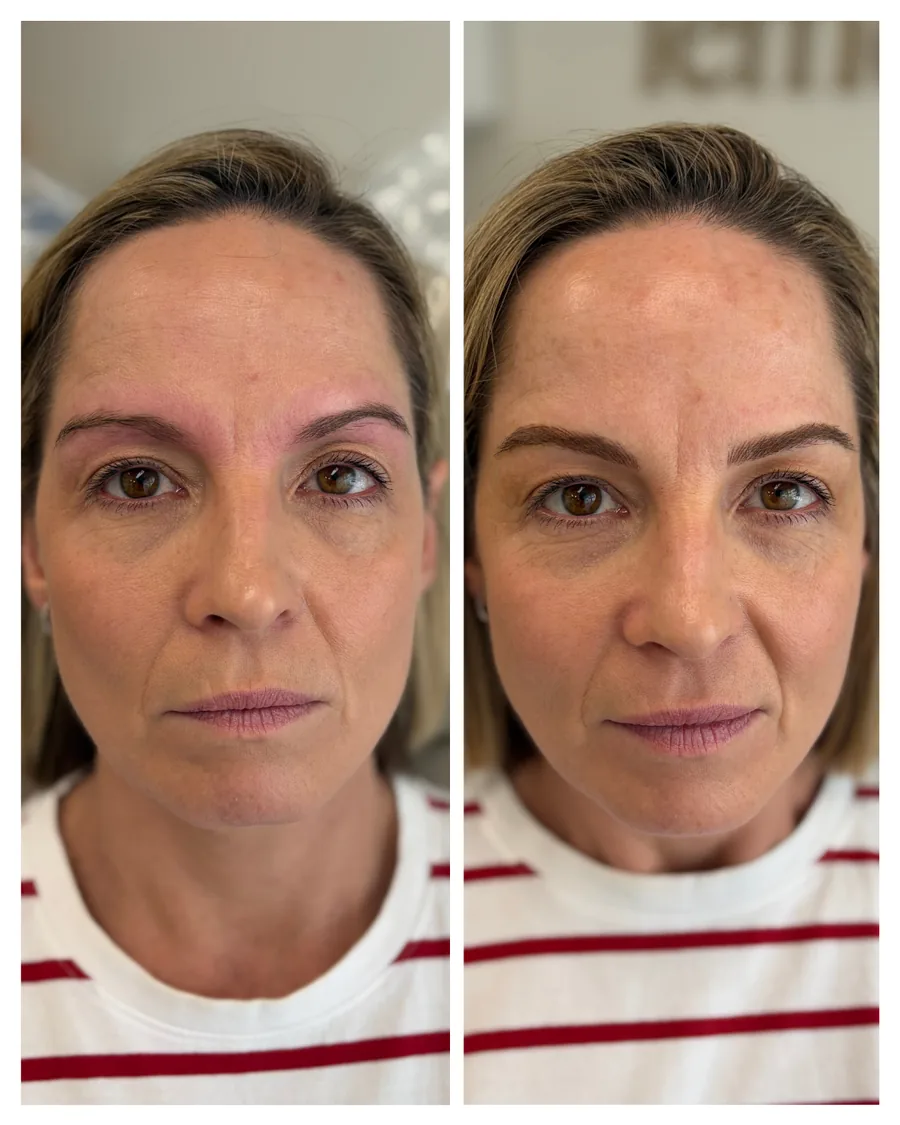 Client before and after brow restoration