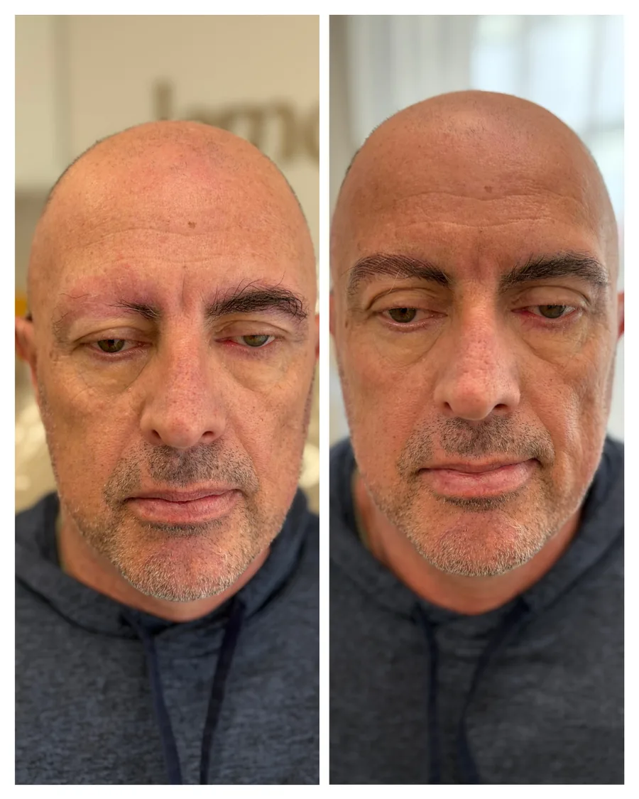 Client before and after brow restoration