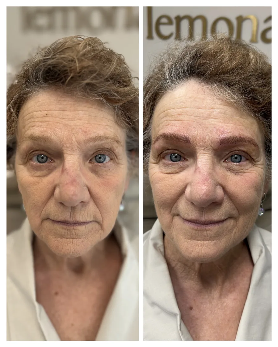 Client before and after brow restoration