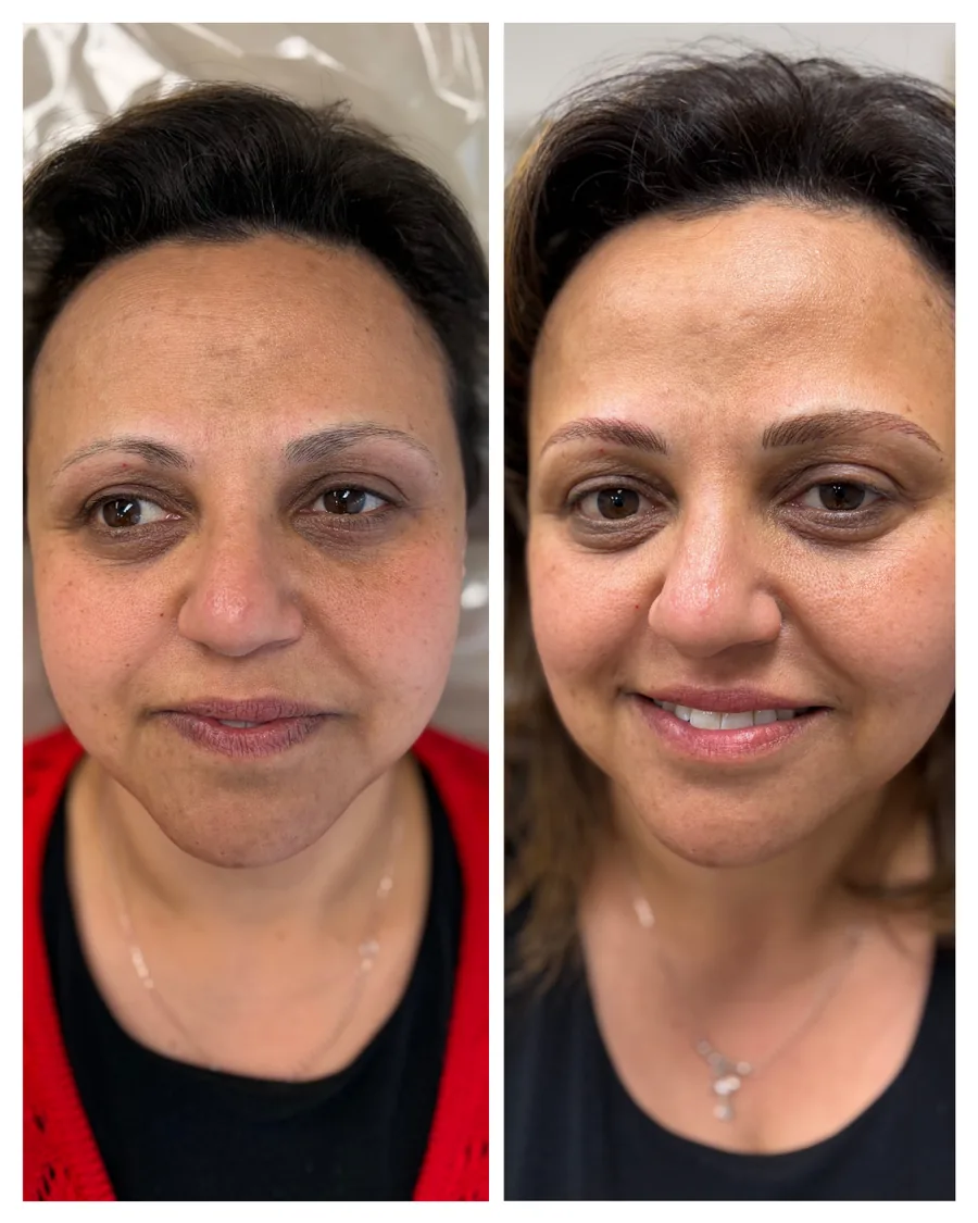 Client before and after brow restoration