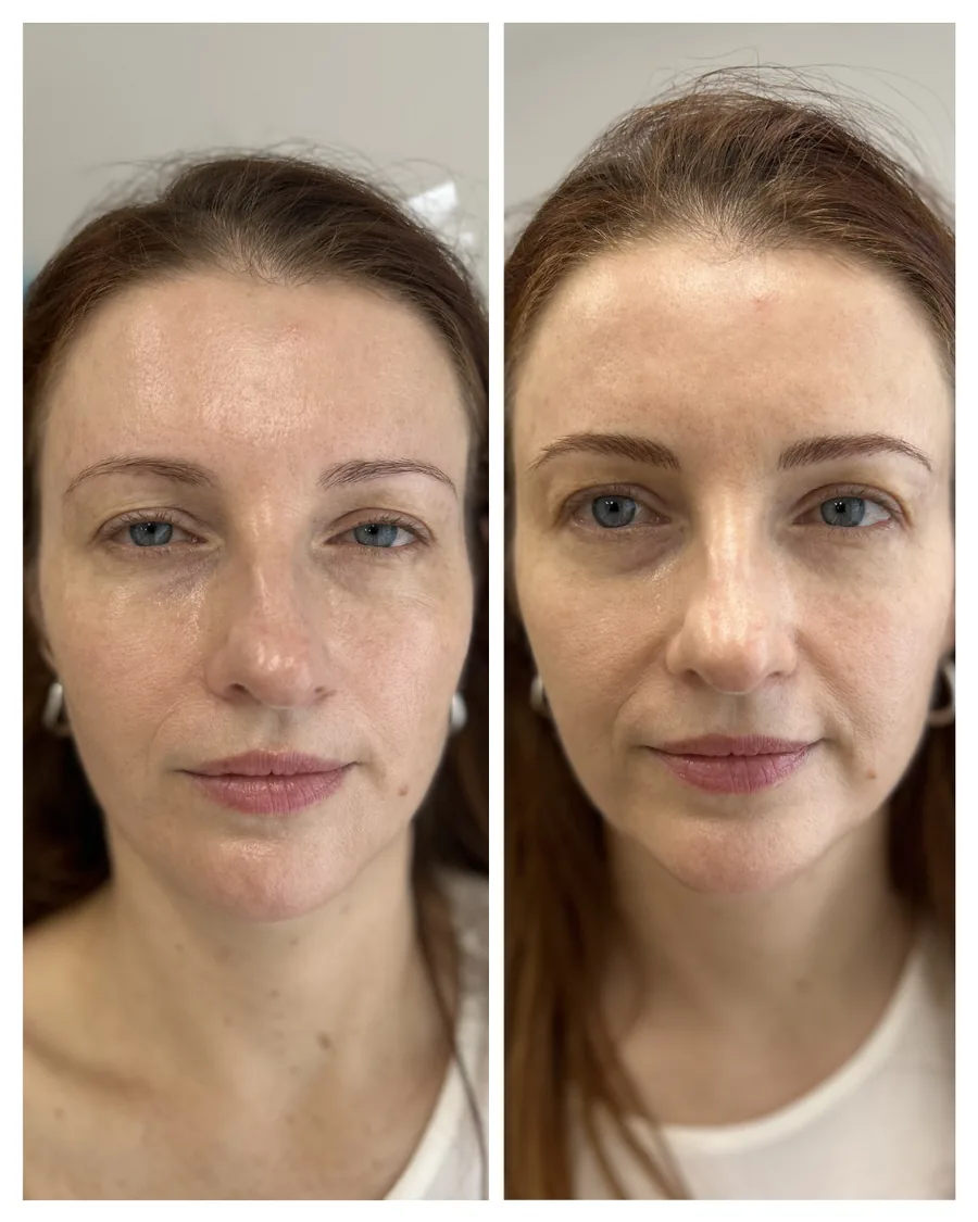 Client before and after brow restoration