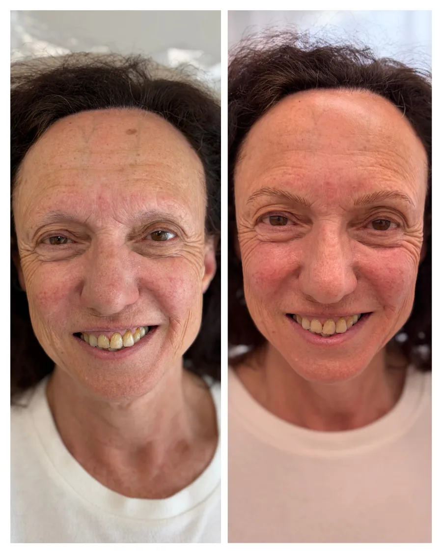 Client before and after brow restoration