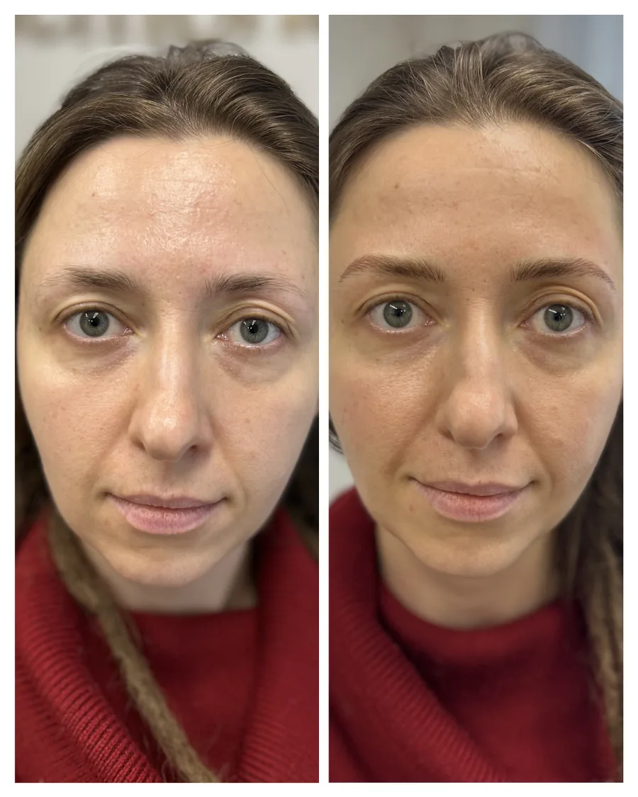 Client before and after brow restoration