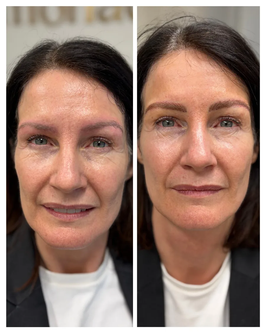Client before and after brow restoration
